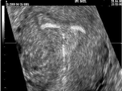 Трехмерное УЗИ матки и внутриматочного средства на основе левоноргестрела (увеличенное фронтальное изображение)