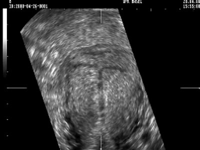 Трехмерное УЗИ матки и внутриматочного средства на основе левоноргестрела - тени (увеличенное фронтальное изображение)