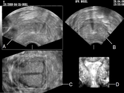 Трехмерное УЗИ матки и внутриматочного средства на основе левоноргестрела (мультиплановая форма и объемное изображение в поверхностном режиме)