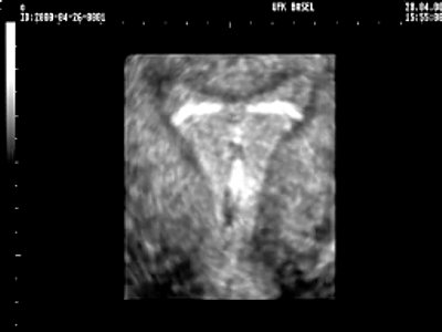Трехмерное УЗИ матки и внутриматочного средства на основе левоноргестрела (увеличенное объемное изображение)