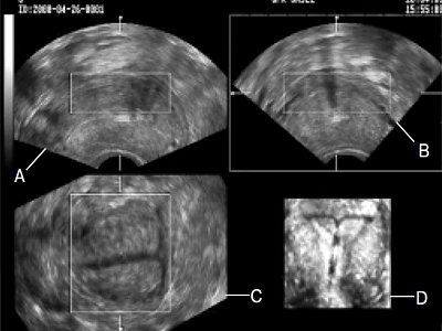 Трехмерное УЗИ матки и внутриматочного средства на основе левоноргестрела - тени (мультиплановая форма и объемное изображение в поверхностном режиме)