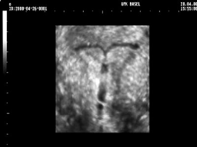 Трехмерное УЗИ матки и внутриматочного средства на основе левоноргестрела - тени (увеличенное объемное изображение)