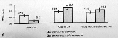 Диаграмма: максимальная систолическая скорость (МАС) в маточной артерии и внутриопухолевом образовании при миоме, саркоме и карциноме шейки матки