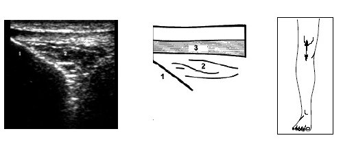 Ультрасонограмма, схема и расположение датчика при исследовании нижнего отдела коленного сустава