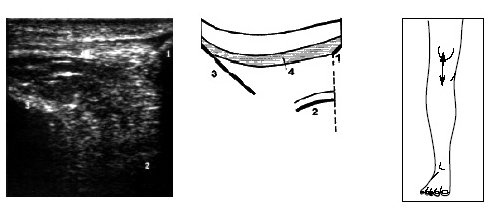 Ультрасонограмма, схема и расположение датчика при исследовании коленного сустава в покое