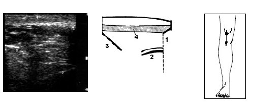 Ультрасонограмма, схема и расположение датчика при исследовании коленного сустава при напряжении m.quadricep
