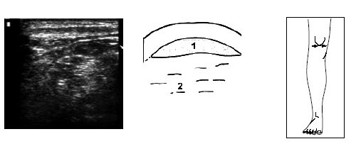 Ультрасонограмма, схема и расположение датчика при поперечном исследовании верхней части коленного сустава