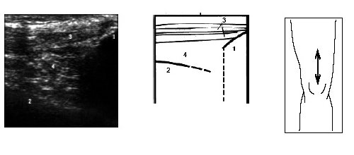 Ультрасонограмма и схема нижнего отдела бедра и надколенника