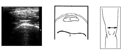 Ультрасонограмма и схема места прикрепления сухожилия m.quadricep в поперечном срезе