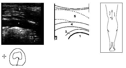 Ультрасонограмма и схемы заднего отдела коленного сустава