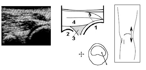 Ультрасонограмма и схемы проекции заднего рога мениска