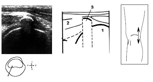 Ультрасонограмма, схема подколенной области и расположение датчика