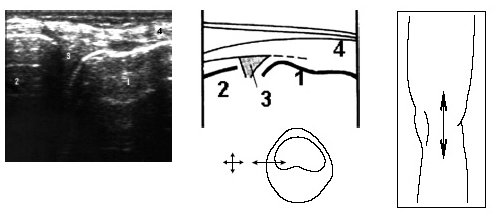 Ультрасонограмма, схема медиального отдела коленного сустава и расположение датчика