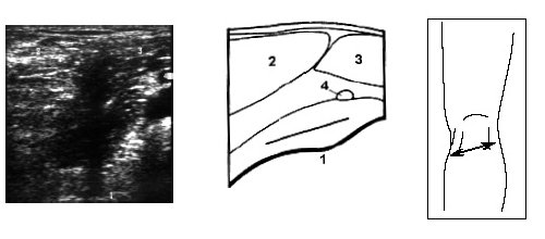 Ультрасонограмма, схема подколенной области и расположение датчика