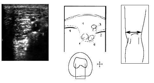 Ультрасонограмма, схема подколенной области и расположение датчика