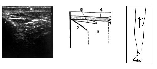 Ультрасонограмма, схема и расположение датчика при исследовании переднего отдела коленного сустава