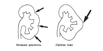 Схема: псевдоопухоли - фетальная долчатость, 'горбатая' почка