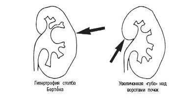 Схема: псевдоопухоли - гипертрофия столба Бертена, увеличенная 'губа' над воротами почек