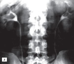 Экскреторная урограмма:  псевдоопухоль - гипертрофия столба Бертена в среднем отделе правой почки