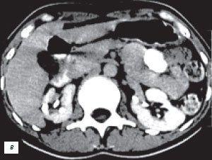 КТ с контрастным усилением: псевдоопухоль - увеличенная 'губа' почек с обеих сторон