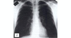 Рентгенограмма органов грудной полости: больной сухим перикардитом (а)