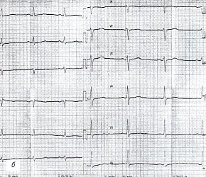 Электрокардиограмма: больной сухим перикардитом (б)