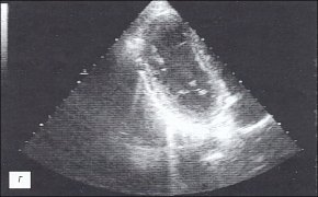 Эхокардиограмма: больной сухим перикардитом (г)