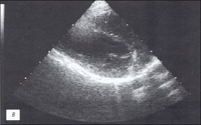 Эхокардиограмма: больной сухим перикардитом (в)