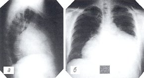 Рентгенограммы грудной полости: больной экссудативным перикардитом (а,б)