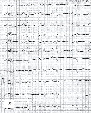 Электрокардиограмма: больной экссудативным перикардитом (в)