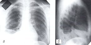 Рентгенограммы грудной полости: больной хроническим туберкулезным плевритом и перикардитом до лечения (а,б)