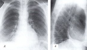 Рентгенограмма грудной полости: больной хроническим туберкулезным плевритом и перикардитом после лечения (д,е)
