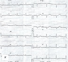 Электрокардиограмма: больной хроническим туберкулезным плевритом и перикардитом после лечения (ж)