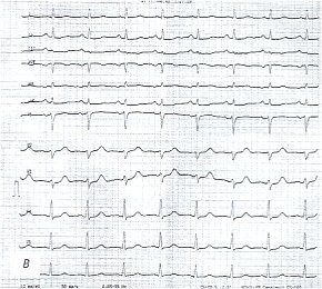Электрокардиограмма: больной хроническим туберкулезным плевритом и перикардитом до лечения (в)