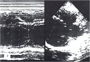 Эхокардиограмма: больной хроническим туберкулезным плевритом и перикардитом после лечения (з)