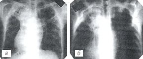 Рентгенограмма: больной констриктивным перикардитом (а,б)