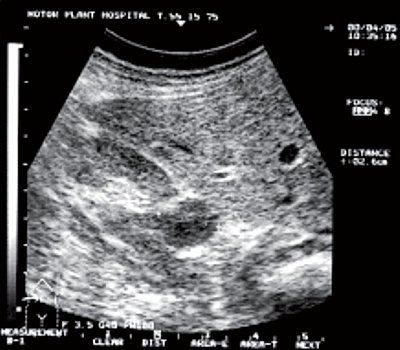 УЗИ: гипоэхогенный участок в периферической части левой доли предстательной железы, нарушающий целостность капсулы