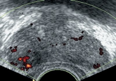 Эхограмма: патологические изменения в сосудах при раке предстательной железы в случае подкапсульной опухоли (энергетическое картирование)
