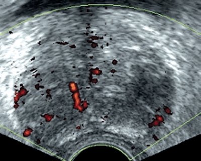 Эхограмма: патологические изменения в сосудах при раке предстательной железы в случае прорастании капсулы (энергетическое картирование)