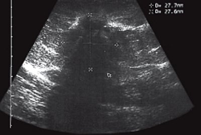 Эхограмма больной раком молочной железы до лечения (B-режим)