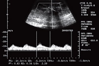 Эхограмма больной раком молочной железы после лечения (импульсный допплер)