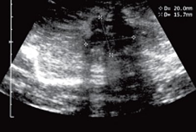 Эхограмма больной раком молочной железы после лечения (B-режим)