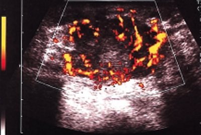 Рак молочной железы - исследование сосудов опухоли до лечения (энергетическое картирование)