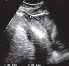 УЗИ: косое сечение в эпигастрии, изображение циркулярно утолщенных стенок желудка в месте их наибольшего утолщения - поражение полого органа