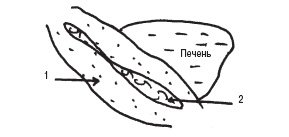 Схема: косое сечение в эпигастрии (1 - утолщенные стенки, 2 - суженная полость желудка)