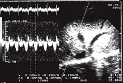УЗИ: доплерэхограмма кровотока в печеночной вене, ишемическая болезнь сердца с нарушением кровообращения