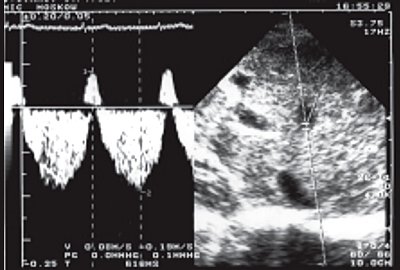 УЗИ: доплерэхограмма кровотока в печеночной вене, цирроз печени