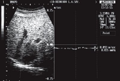 УЗИ: доплерэхограмма кровотока в печеночной вене, псевдопортальный кровоток при ишемической болезни сердца с нарушением кровообращения