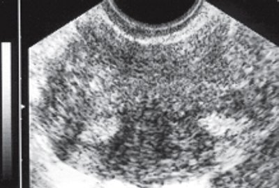 ТВУЗИ нормальной матки: поперечное сканирование в области дна