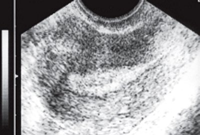 ТВУЗИ нормальной матки: продольное сканирование по центру матки